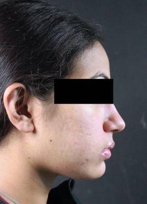 Acne after