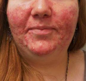 Acne before