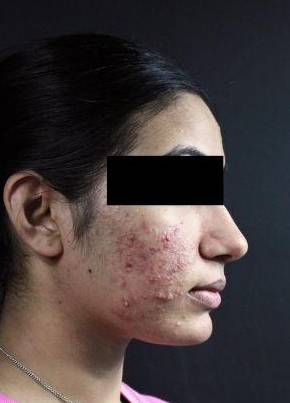 Acne before
